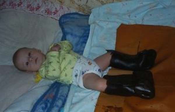 Парафино-озокеритовые аппликации