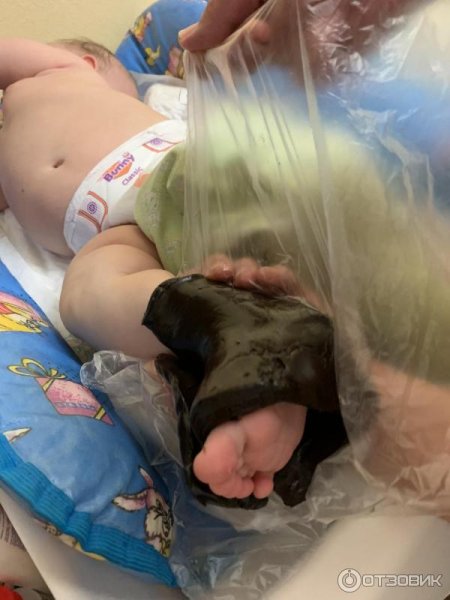 Теплолечение озокеритом