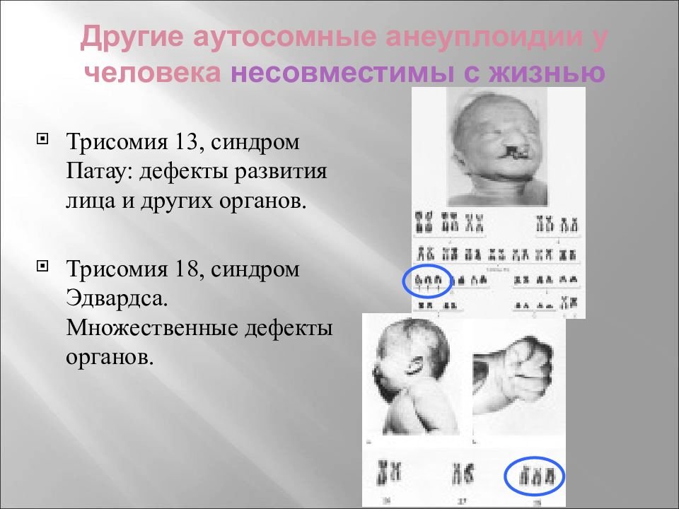 Аутосомные хромосомы заболевание. Хромосомные аномалии (синдром Патау, трисомия 13. Синдром Патау трисомия по 13 хромосоме кариотип. Синдром Патау хромосомная мутация. Синдром Патау трисомия 13.