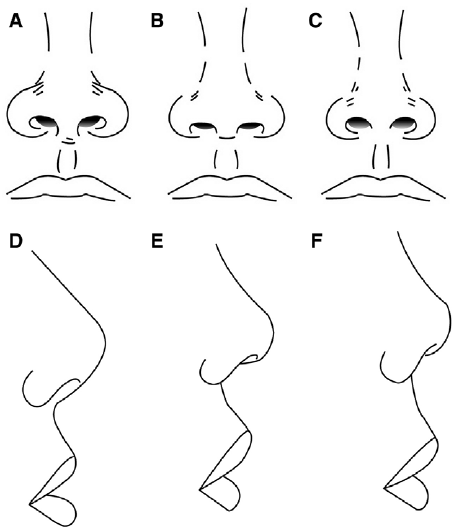 Виды носов. Типы Носов. Формы Носов у человека. Классическая форма носа. Типы форм носа.