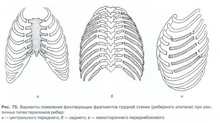 Кости Кощея грудная клетка