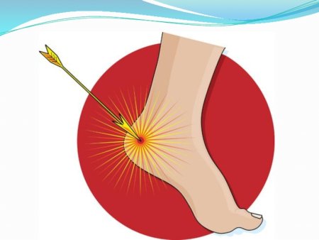 Ахиллесова пята рисунок