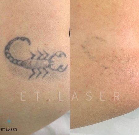 Выжигание Татуировки лазером