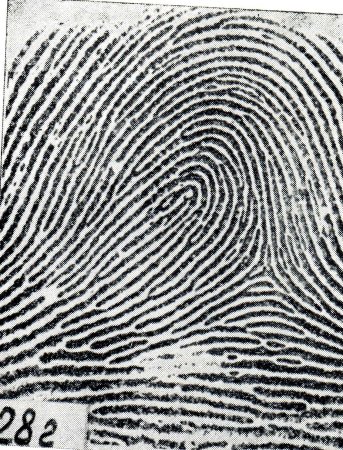 Петлевой папиллярный узор