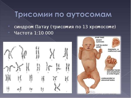 Синдром Патау трисомия по 13 хромосоме кариотип