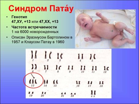 Синдром Патау (трисомия в 13-Ой хромосоме);