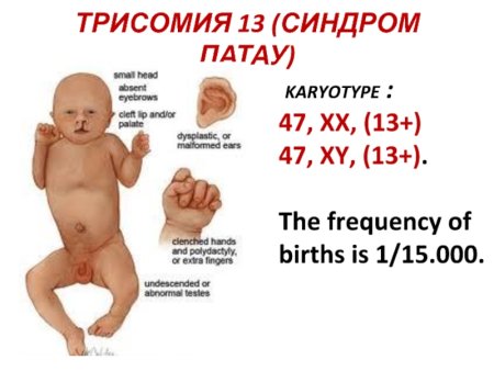 Синдром трисомии хромосомы 8