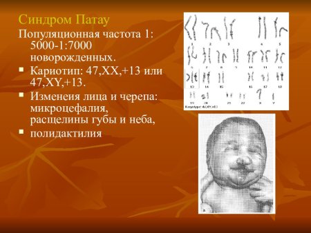 Гипотелоризм синдром Патау