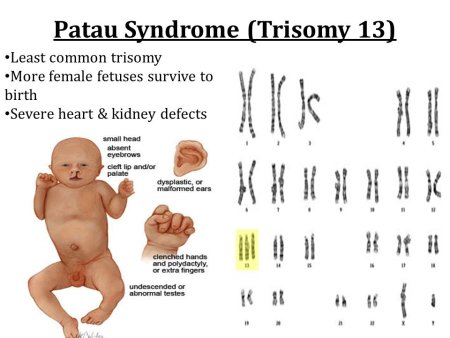 Хромосомная трисомия 21 18 13