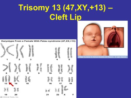 Синдром Патау анофтальмия