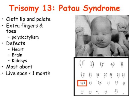 Синдром Патау клинические проявления заболеваний.