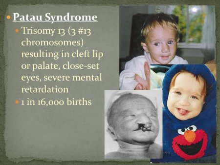 Хромосомные болезни Патау