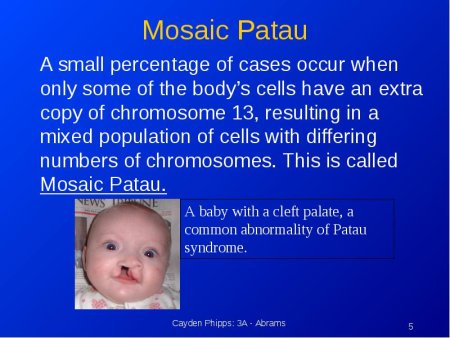Синдром Дауна трисомия 21 хромосомы