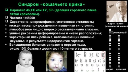 Синдром Патау хромосомные аномалии