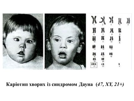 Синдром Эдвардса Патау симптомы