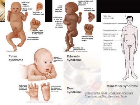 Эдвардс синдром кариотип