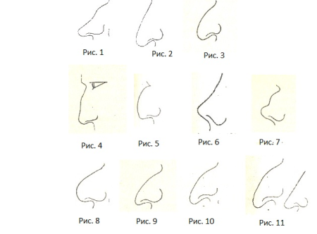Типы курносых Носов
