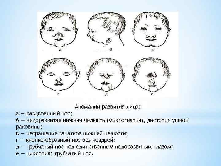 Развитие лицевой области. Врожденные пороки развития лица и шеи причины. Рожденные пороки развития лица. Врожденные патологии лица.