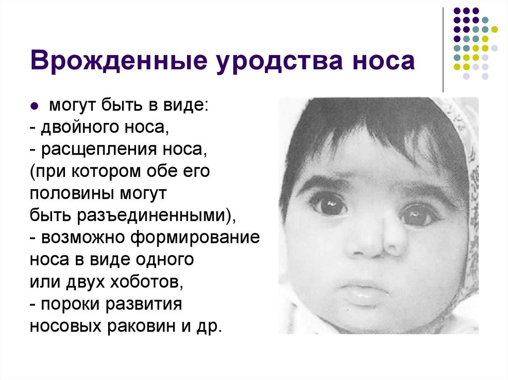 Какой нос будет у ребенка. Врожденные аномалии носа. Врожденная патология носа. Врожденный порок развития носа. Врожденные уродства и аномалии развития.