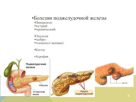 Экзокринная недостаточность поджелудочной