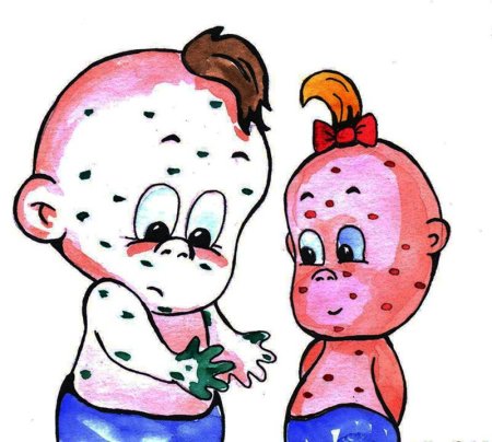 Ветрянка ветряная оспа