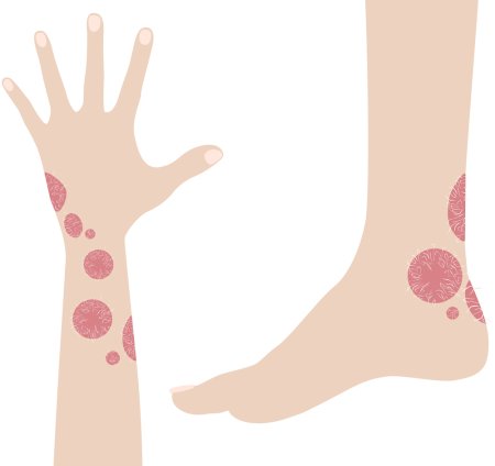 Кожные заболевания иллюстрации