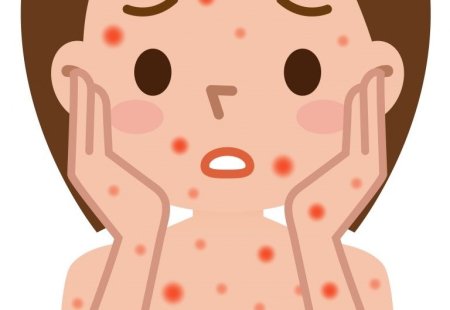 Корь краснуха крапивница ветрянка