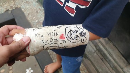 Разрисованный гипс на руке ребенка