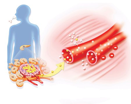 Diabetes mellitus Type 1