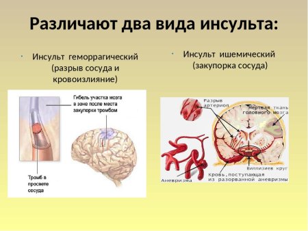 Презентация по теме инсульт