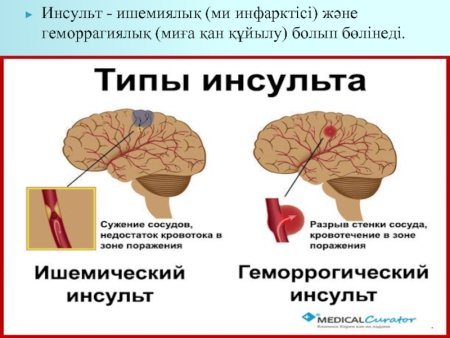 Ишемический инсульт презентация