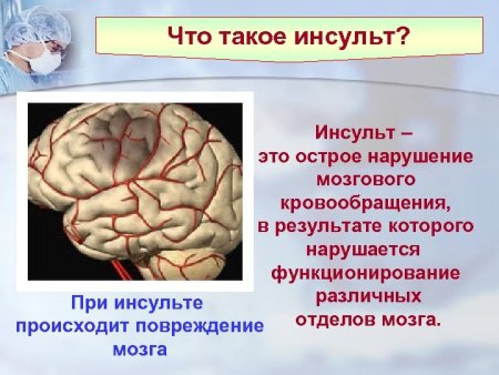 Инсульт это острое нарушение мозгового кровообращения