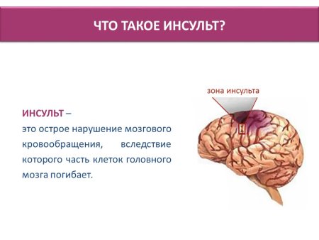 Инсульт картинки для презентации
