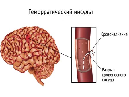 Геморрагический инсульт макропрепарат