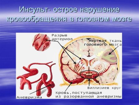 Острое нарушение головного кровообращения