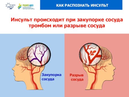 Что происходит при инсульте