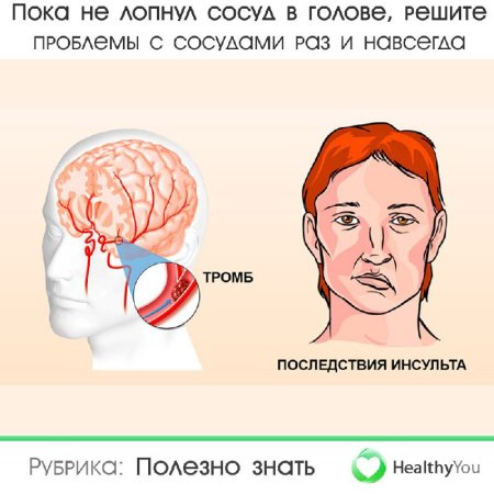 Инсульт картинки