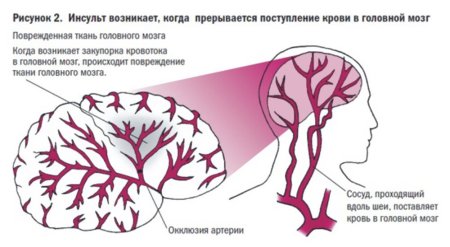 Ишемический инсульт схема