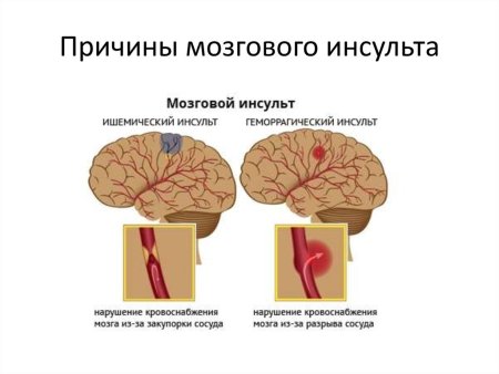 Основным признаком инсульта мозгового является: