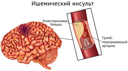 Ишемический инсульт головного мозга