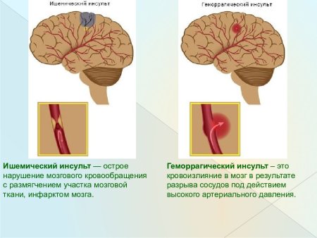 Ишемический инсульт схема