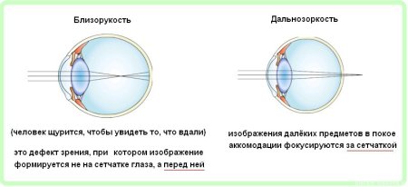 Строение глаза близорукость и дальнозоркость