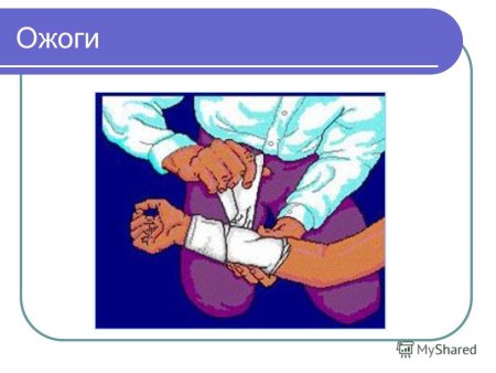 Ожоги рисунки для презентаций