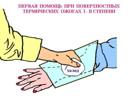 Оказание первой помощи при ожогах рисунок