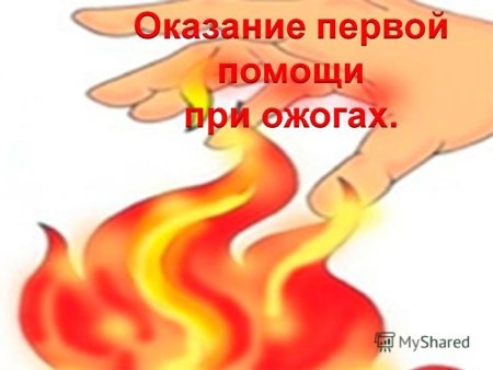 Помощь при ожогах от огня