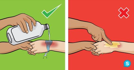 Первая помощь при ожогах