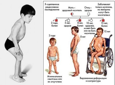 Мышечная дистрофия Дюшенна Тип наследования