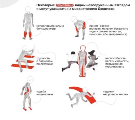 Мышечная дистрофия Дюшенна генотип