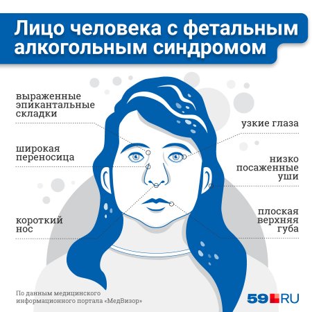 Фетальный алкогольный синдром