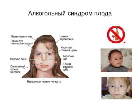 Фетальный алкогольный синдром